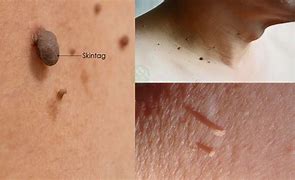 Image result for How to Remove Armpit Skin Tags