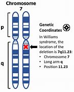 Image result for Williams Syndrome Karyotype