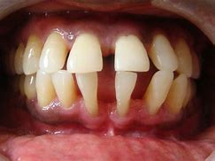 Image result for Calculus Dental