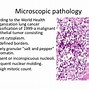 Image result for Non Small Cell Squamous Lung Cancer Stage 4