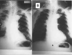 Image result for Stage 4 Non Small Lung Cancer