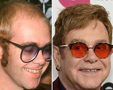 Image result for Elton John Receding Hair