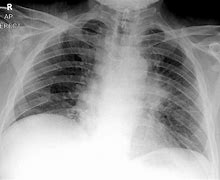 Image result for What Is Small Cell Lung Cancer