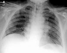 Image result for Lung Carcinoma
