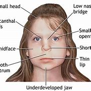 Image result for Scan Fetal Alcohol Syndrome