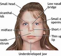 Image result for Fetal Alcohol Syndrome in Adults