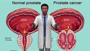 Image result for Prostate 45G