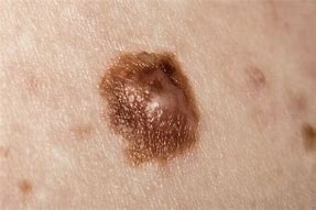 Image result for First Stage Melanoma