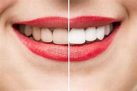 Image result for Mettre Les Dents