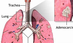 Image result for Stage 4 Adenocarcinoma Lung Cancer