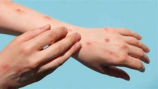 Image result for Monkeypox Symptoms