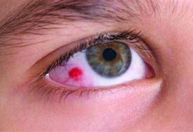 Image result for Eye Cancer
