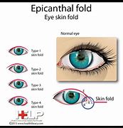 Image result for Epicanthal Folds