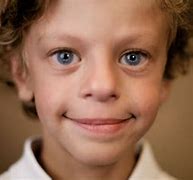 Image result for Williams Syndrome Sign