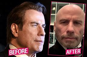 Image result for John Travolta Lost His Hair