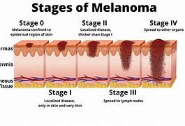 Image result for Stage 2 Melanoma Cancer