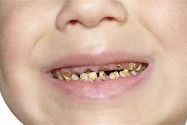 Image result for Dents Pourries Enfants
