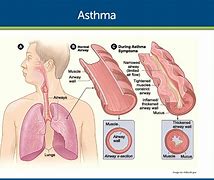 Image result for Asthma Care Pathway