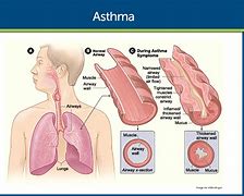 Image result for Images of Asthma Disease