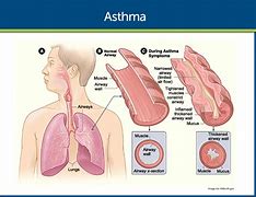 Image result for Diagram of the Pathogenesis of Asthma