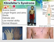Image result for Kilinefelters Syndrome Symptoms On Body