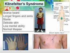 Image result for Symptoms of Klinefelter Syndrome