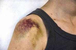 bruise 的图像结果