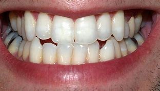 Image result for Dents in Car Hoods