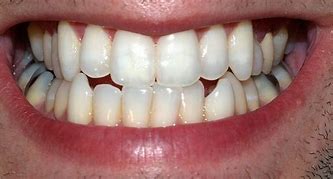 Image result for Belles Dents