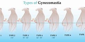 Image result for Gynecomastia in Females