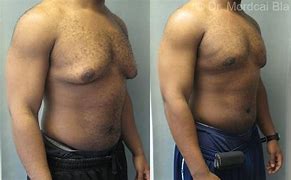Image result for +With Treated Gynecomastia Lyxpo