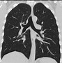 Image result for Stages of Lung Cancer