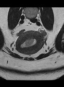 Image result for Stage 4 Endometrial Cancer