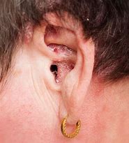 Image result for Ear Wax Infection