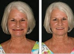 Image result for Before and After Dentures