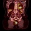 Image result for Non Small Cell Lung Cancer CT