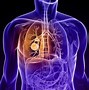 Image result for Lung Cancer Symptoms Disease