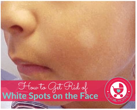 5 ways to get rid of white spots on the face of your child