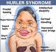 Image result for Hurler Syndrome Hair