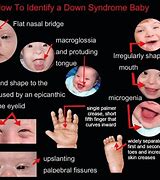Image result for Down Syndrome That Affects System