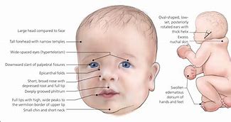 Image result for Noonan Syndrome Baby