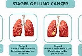 Image result for Lung Cancer Stages 1-4
