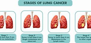 Image result for Stage 5 Lung Cancer