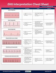 Image result for Arrhythmia Cheat Sheet