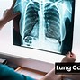 Image result for Stages of Lung Cancer 1 5