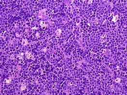 Image result for Burkitt's Lymphoma Peripheral Smear