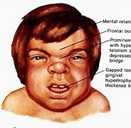 Image result for Gargoyle Syndrome Medical