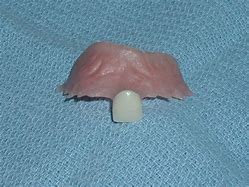 Image result for Dental Flipper Picture for Front Tooth