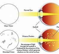 Image result for Shapes of Eye Floaters