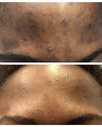 Image result for Hyperpigmentation in African American Skin